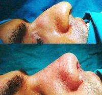 Newport Beach CA Male Rhinoplasty Nose Bridge Before And After