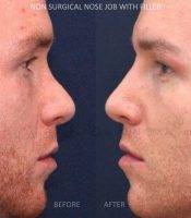 Non Surgical Rhinoplasty In Saint Louis, MO For Man Before And After Photos