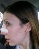 Nose Augmentation Florida Involves Reshaping The Nasal Cartilage