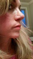 Nose Beaty Surgery Typically Refers To A Cosmetic Change To The Nose