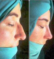 Nose Job In Izmir Turkey To Remove A Bump Before And After Pics