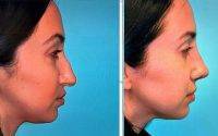 Nose Job Procedure Jounieh Lebanon Before And After