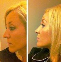 Nose Job Revision In Manchester, UK Photos