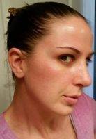 Nose Job Surgery Can Greatly Enhance Your Appearance