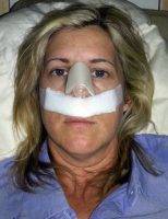Nose Reconstruction Surgery In Kitchener, Ontario Involves The Surgical Reshaping Of The Nose