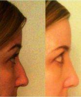 Nose Surgery Florida Patient Before And After