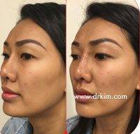 Nose Surgery Operation By Dr Kim