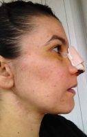 Nose Surgery Plastic In Corpus Christi TX Helps To Match The Nose To The Individual Facial Features And Proportions