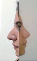 Operation For Nose Is The Art Of Making A Prominent, Misshapen, Or Unattractive Nose Look More Normal