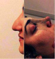 Ozerk Demiralp, MD Nose Surgery Plastic In Bursa Turkey To Correct A Breathing Issue Photos