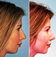 Perfect Nose Shape Your Face Lebanon Result