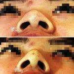 Perfect Shape Of Nose For Asian People