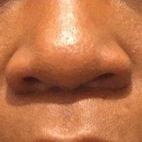 Pics Of Nose Job For Asian, African American, And Hispanic Ethnic