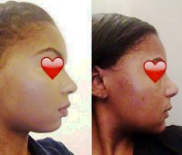 Pittsburgh, PA Cosmetic Surgery Ethnic Nose Reshaping Before And After By Dr. Fernau