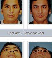 Pittsburgh Plastic Surgeon Dr Heil's Perfect Male Nose Shape For Your Face Before And After Photos