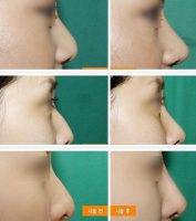Plastic Nose Surgery