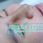 Plastic Surgery Asian Nose