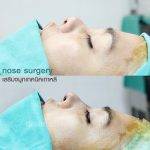 Plastic Surgery Nose Surgery