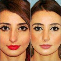 Plastic Surgery Of Nose In Montreal, Quebec Is A Very Safe Procedure, And Complications Are Uncommon