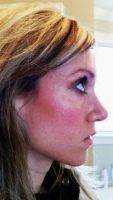 Plastic Surgery On Nose Is A Very Popular Procedure In Louisiana