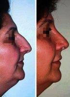 Preop And Post Op Rhinoplasty In Montreal, Quebec