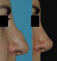 Preop And Postop Rhinoplasty Nose Surgery