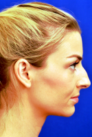 Primary Rhinoplasty Louisiana For Decreasing Or Increasing The Size Of The Nose