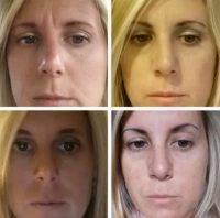 Reconstructive Nose Surgery Cost In Krakow Poland