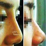 Rhinoplasty Ethnic Before And After