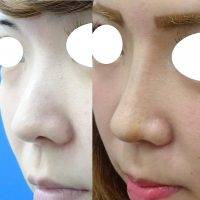 Rhinoplasty For Asian Nose Is One Of The Oldest Procedures In Facial Plastic Surger