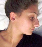 Rhinoplasty Is One Of The Most Common Of All Plastic Surgery Procedures In Manchester, GB
