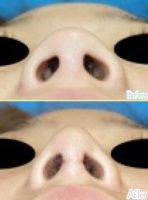 Rhinoplasty Is The Second Most Popular Procedure For Asian Women
