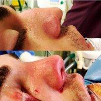 Rhinoplasty Long Nose For Man In CA Image