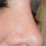 Rhinoplasty Open Can Correct Nasal Tip That Is Large Or Bulbous, Drooping Or Too Upturned