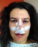 San Bernardino Plastic Surgery For The Nose