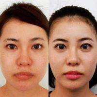 Secondary Asian Rhinoplasty Before And After