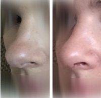 Slight Nose Job CA, US Woman Before And After