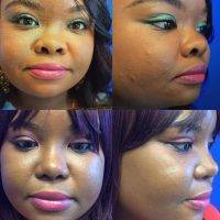 Thailand Ethnic (African American) Cosmetic Surgery Of Nose Before And After