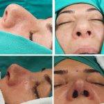 The Asian Nose Has Thicker Skin, With A Deeper And Flatter Radix, And A Lower Or Sometimes Depressed Nasal Bridge