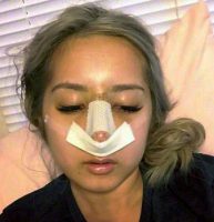 The Perfect Asian Nose After Nose Surgery In Texas