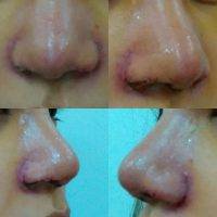 The Tip Of The Asian Nose Tolerates Slightly Less Definition And Projection