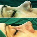 Tip Nose Job Is One Of The Most Performed Procedures In Turkey And In The World