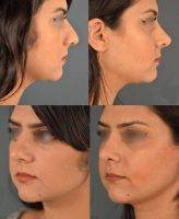 With Cosmetic Surgery Rhinoplasty In Elizabeth NJ You Can Achieve An Improved, But Natural Contour