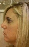 With Fresno Cosmetic Surgery On Nose You Can Achieve A Balance Between The Nose And The Rest Of The Face
