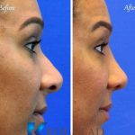 A Bulbous Nasal Tip Can Be The Consequence Wide Cartilage Arches