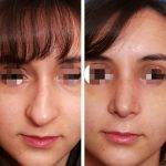 A Bulbous, Rounded Nasal Tip Before And After Photos