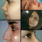 A Good Iran Rhinoplasty Surgeon Recognizes The Ethnic Features That Identify A Person Culturally