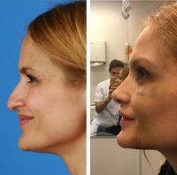 A Revision Nose Job Is Usually Determined If There Is A Residual Dorsal Hump, The Tip Is Still Bulbous, Or There Is Still A Nasal Airway Obstruction