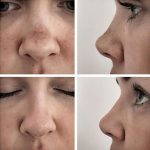 Achieving A Natural Appearance After Bulbous Nose Rhinoplasty