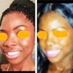 African American Nose Job Before And After Images
